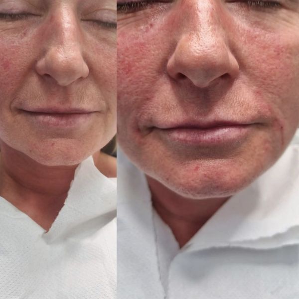 Before and After Treatment