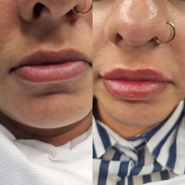 Lip Filler before and after