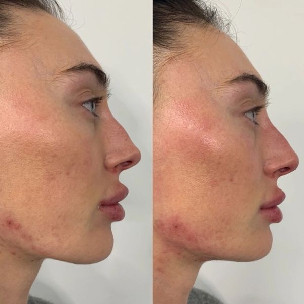 Non-surgical Rhinoplasty Before and After