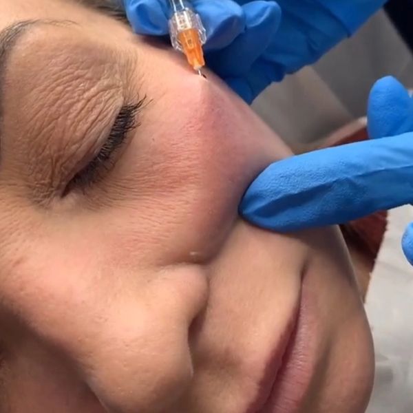 Cheek Filler Treatment