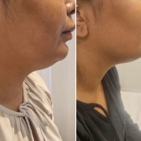Chin Filler Before and after