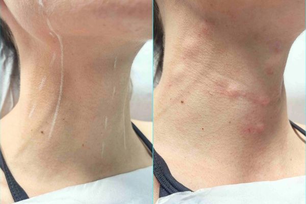 Skin Booster Before and After the Treatment