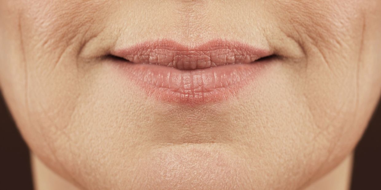 Sad Smile / Down Turn Mouth Lines