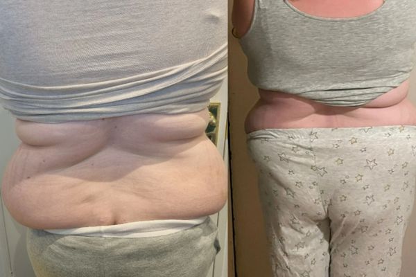 Before and after treatment