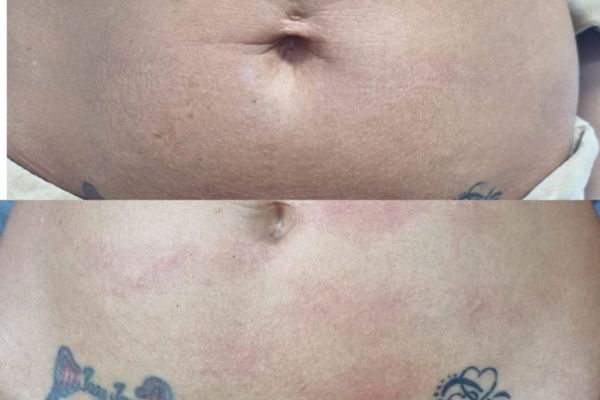 Before and after treatment