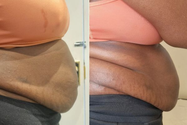 Before and after treatment