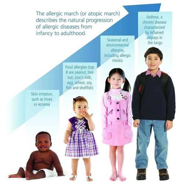 ALLERGIC MARCH/ ALLERGY MARCH