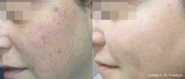 Before and after images showing improved skin clarity and reduced pigmentation.