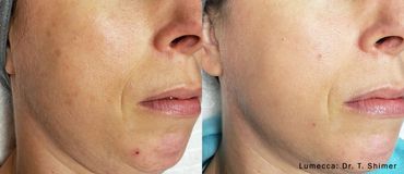 Before and after facial skin treatment showing reduced blemishes and improved texture.