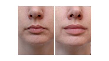 Before and after lip enhancement showing fuller lips.