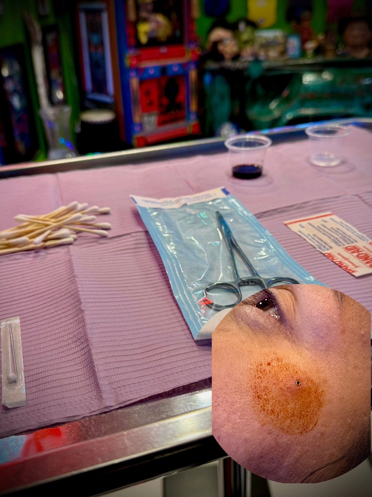 Dermal removal services!