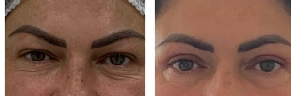 Antes e depois de cirurgia das pálpebras