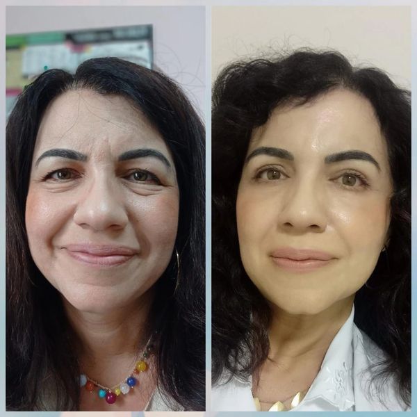 Antes e Depois de Blefaroplastia Dra Florence