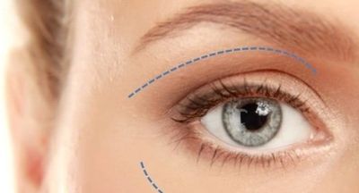 Cirurgia das Pálpebras