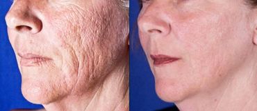 Laser de CO2 Fracionado