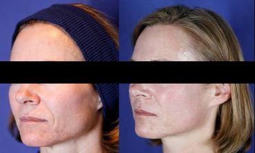 Antes Depois Laser de CO2