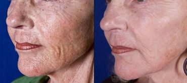 Antes e depois laser de co2 fracionado