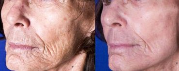 Antes e depois resurfacing