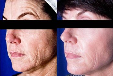 Antes depois resurfacing com laser de co2