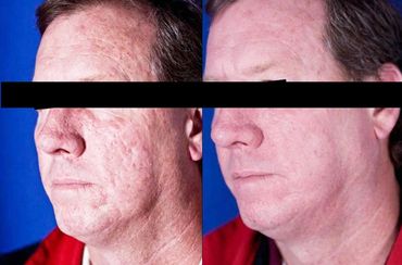rejuvenescimento com laser de CO2 fracionado