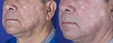 Rejuvenescimento com laser de co2