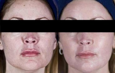 Rejuvenescimento com Laser fracionado