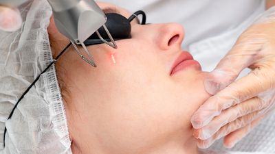 Blefaroplastia Laser