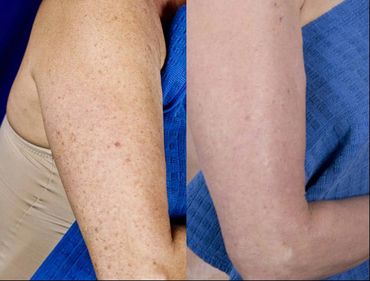 Melanose com laser de co2