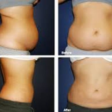 Cavi-Lipo ultrasound and laser treatments for safe fat loss