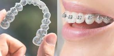 Comparison of clear aligners and traditional metal braces on teeth.