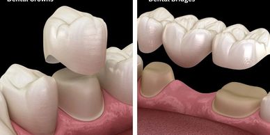Illustration comparing dental crowns and dental bridges on prepared teeth.