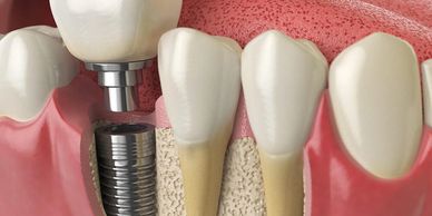 Dental implant being placed in the jawbone between natural teeth.