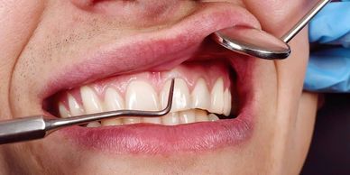 Close-up of dental checkup with tools inspecting healthy teeth and gums.