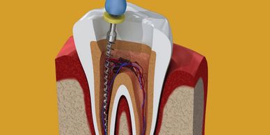 Illustration of a root canal procedure inside a tooth.