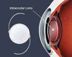 Intraocular lens implant for cataract surgery.