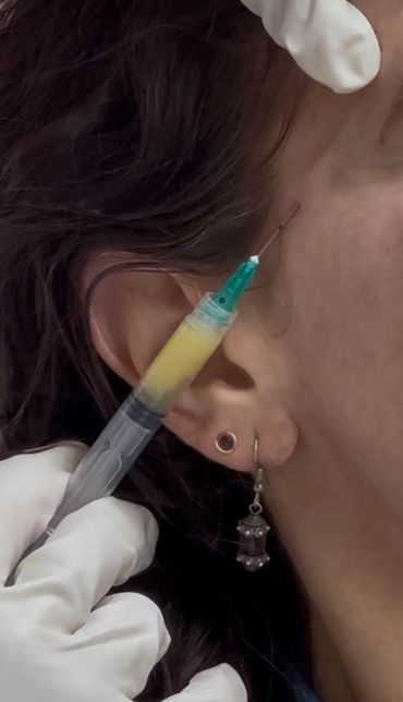 Close-up of a woman receiving a cosmetic injection near her temple.