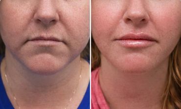 Before and after facial rejuvenation treatment showing smoother skin and fuller lips.