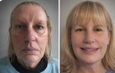 Before and after facial rejuvenation showing dramatic skin and hair transformation.