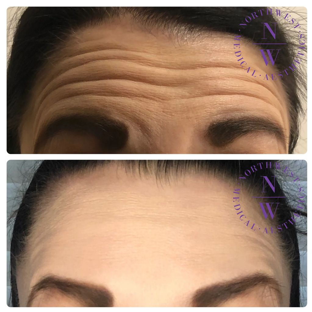 Northwest Medical Aesthetics photo of neuromodulator treatment with Xeomin on forehead lines