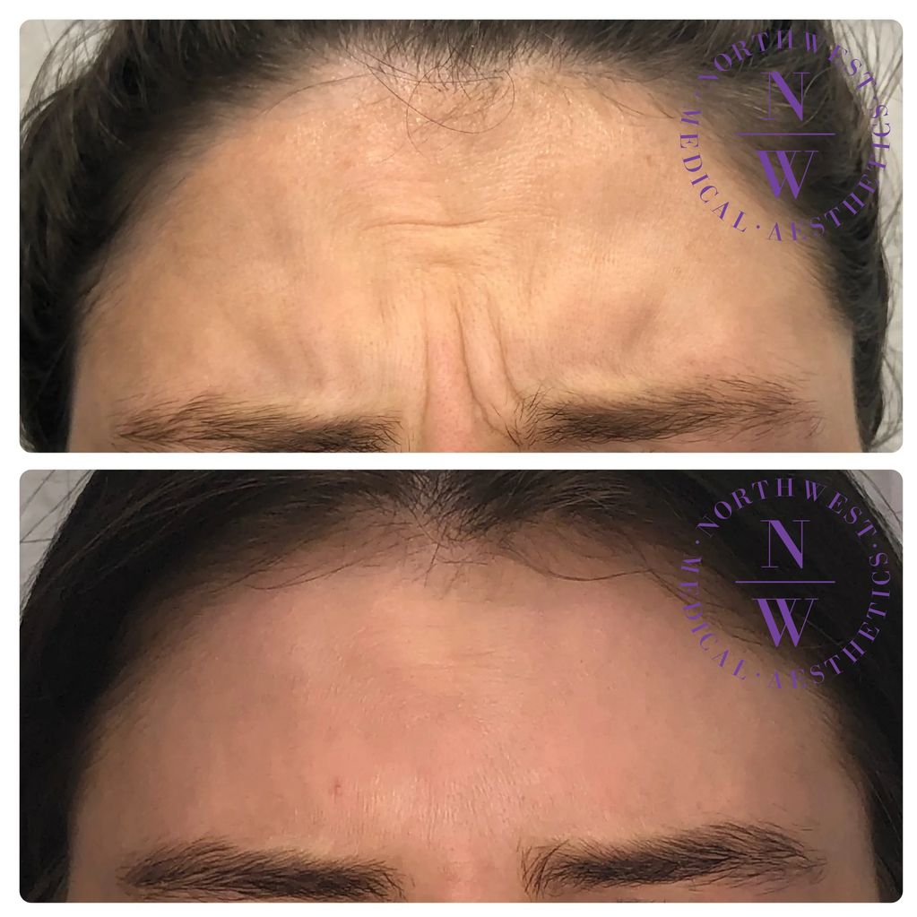 Northwest Medical Aesthetics photo of preventive wrinkle treatment with Xeomin on frown lines