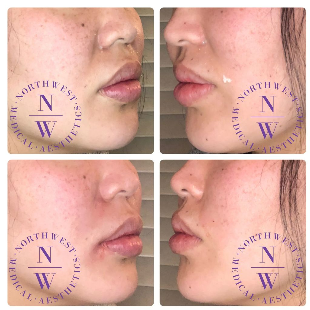 Northwest Medical Aesthetics photo of dermal filler treatment with Juvederm on nasolabial lines
