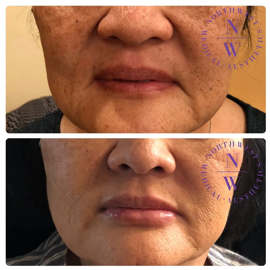 Northwest Medical Aesthetics photo of dermal filler treatment with Juvederm on lip/nasolabial lines