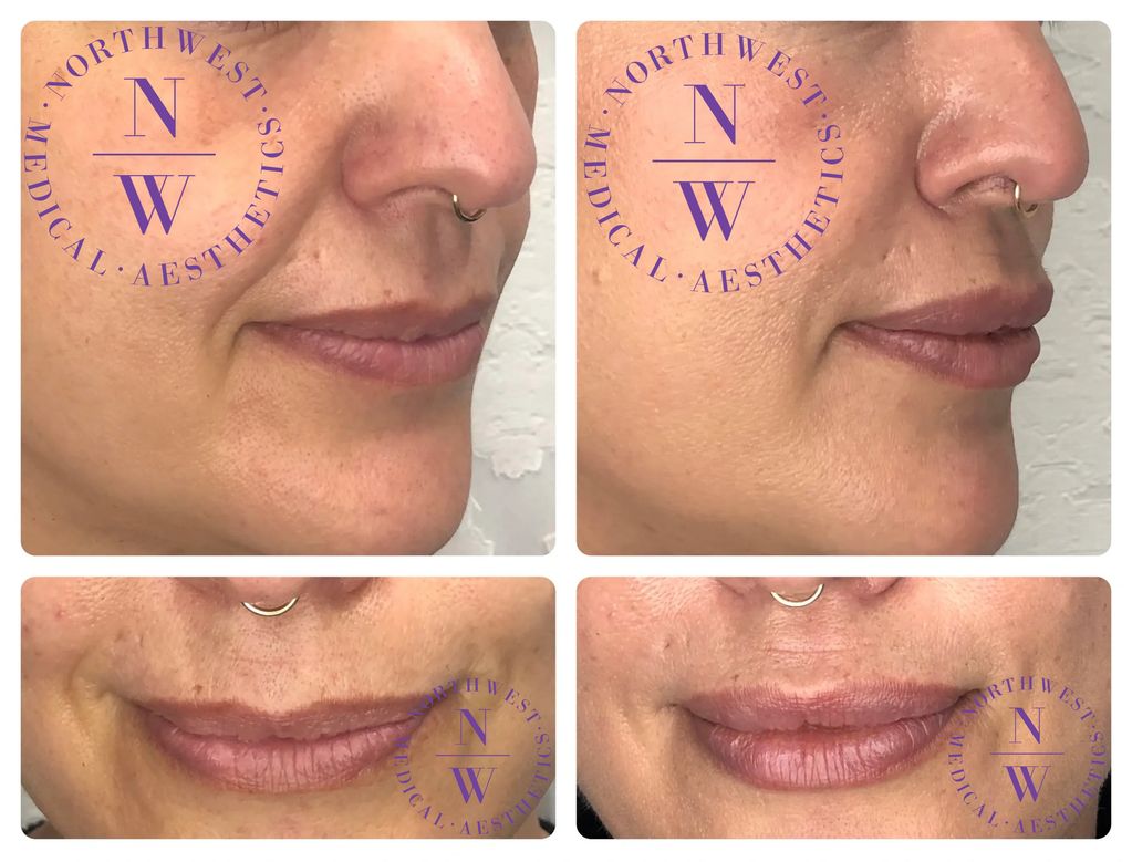 Northwest Medical Aesthetics photo of dermal filler treatment on cheek, lip, and nasolabial lines.