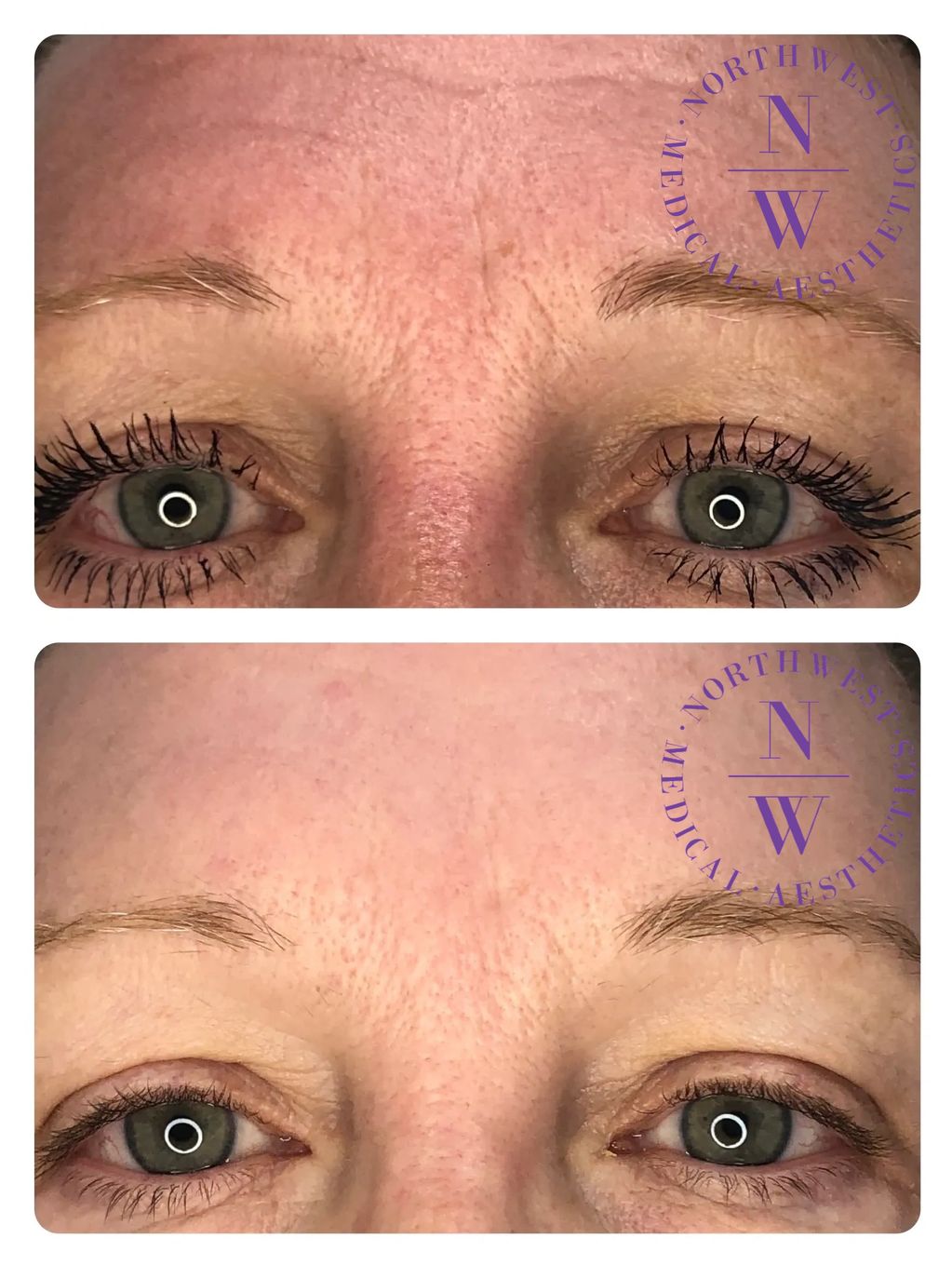 Northwest Medical Aesthetics photo of Smooth PDO threads on glabella/frown lines.