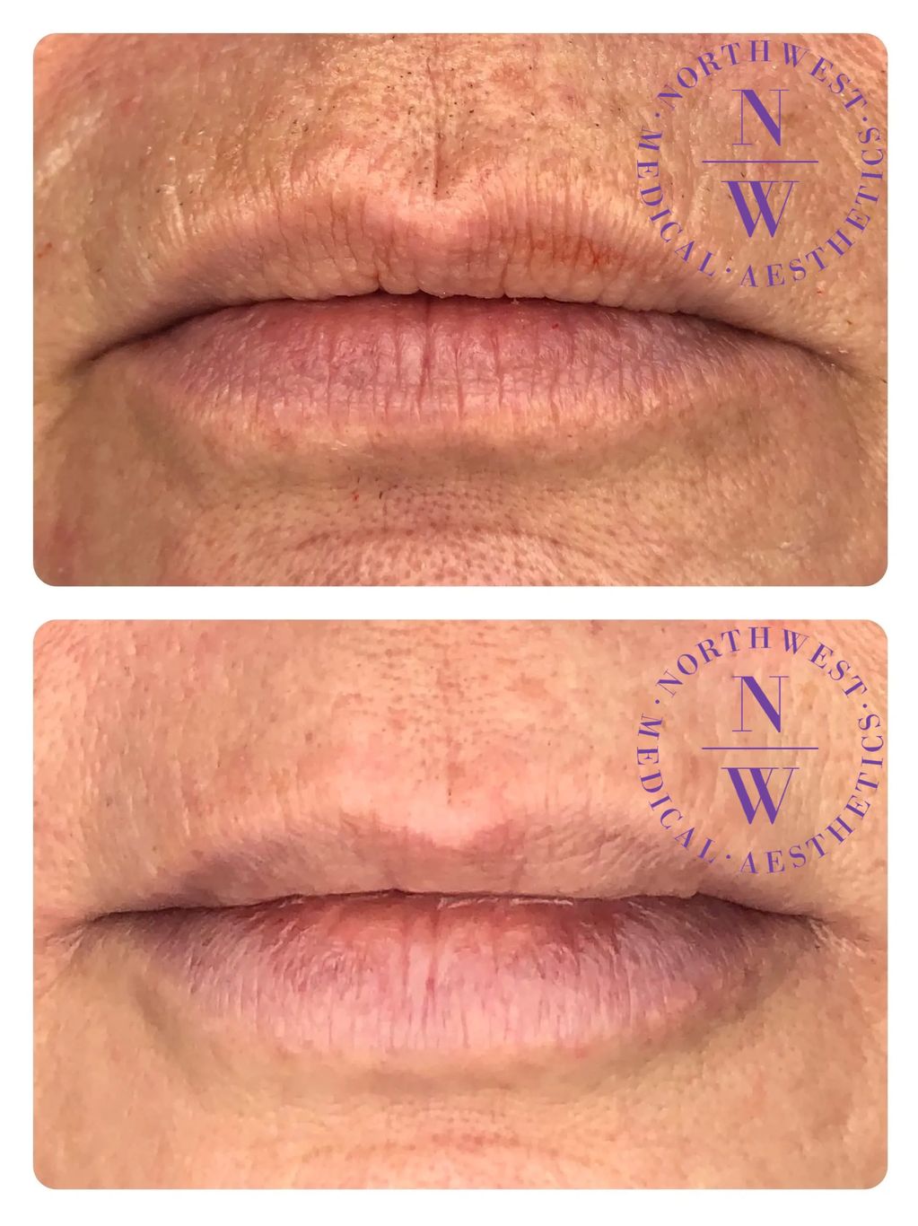 Northwest Medical Aesthetics photo of dermal filler to lip/perioral lines and lip border PDO threads