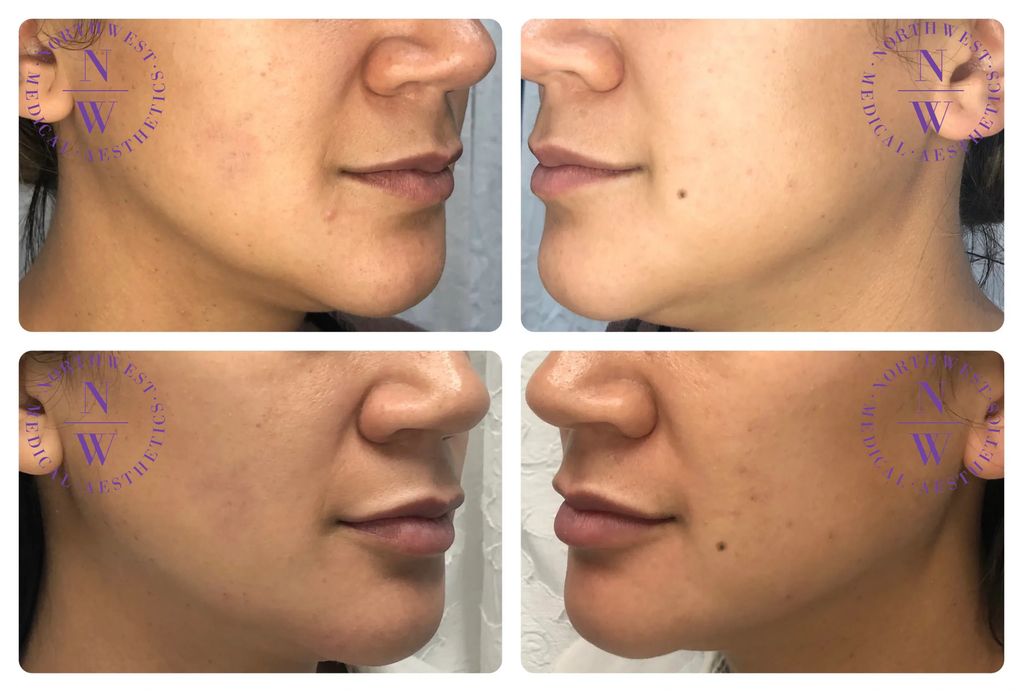 Northwest Medical Aesthetics photo of dermal filler treatment on lip/cheek/jawlines