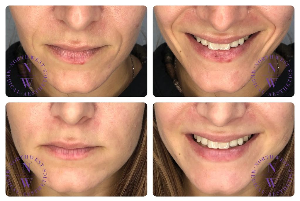 Northwest Medical Aesthetics photo of dermal filler treatment on smile lines.