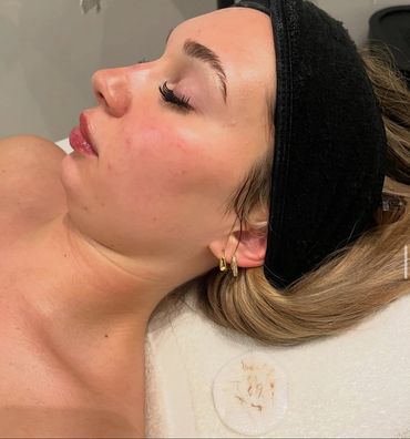 Dermaplane Service in Sebastian, FL