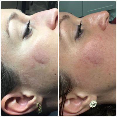 Scar Reduction