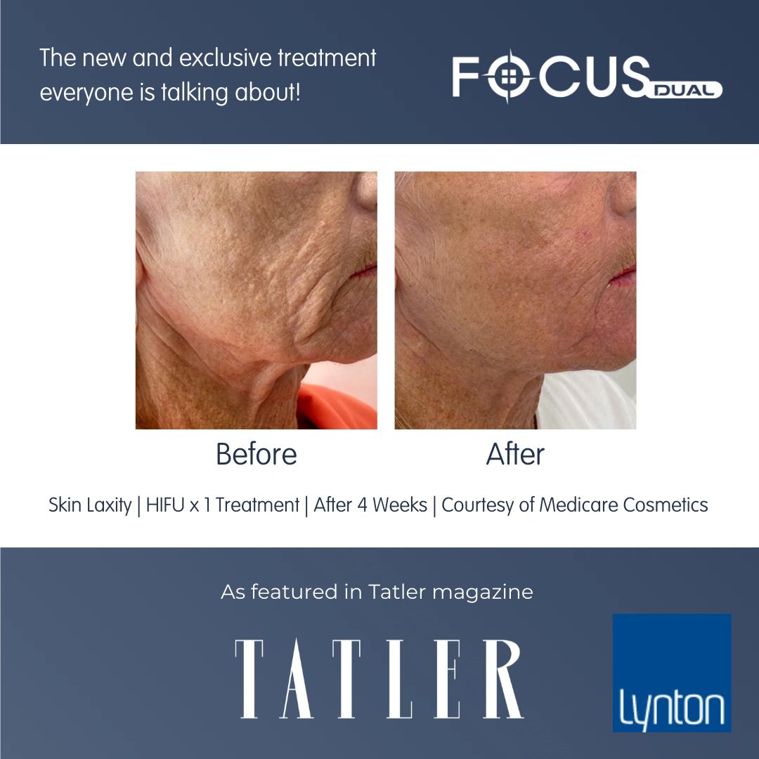 Before and after images showing skin laxity improvement after one HIFU treatment.